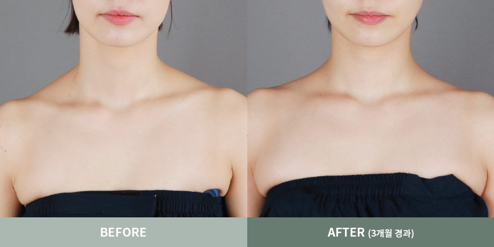 전후사진03