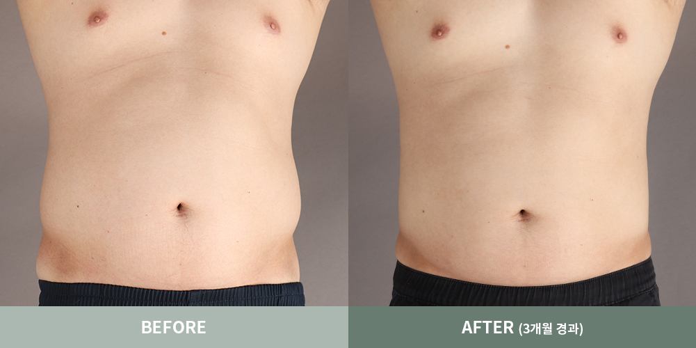 전후사진03